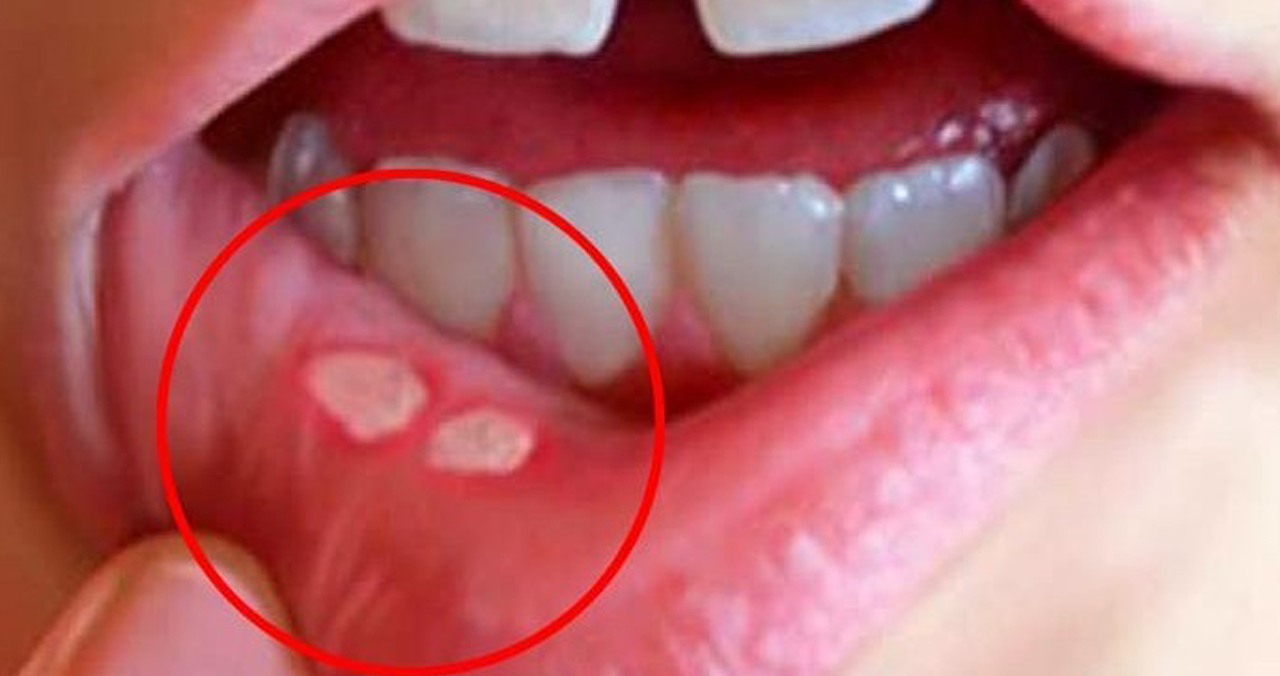 मुख, ओठ र जिब्रोमा खटिरा आयो ? यस्ता छन् घरेलु उपाय